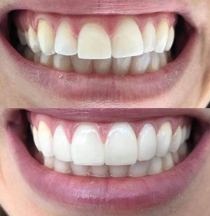 Change of total smile