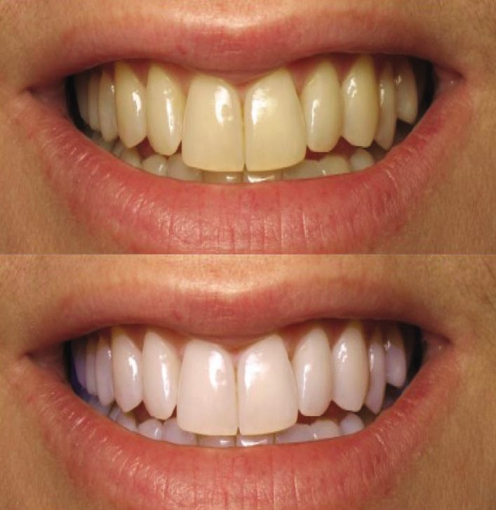 Dental whitening
